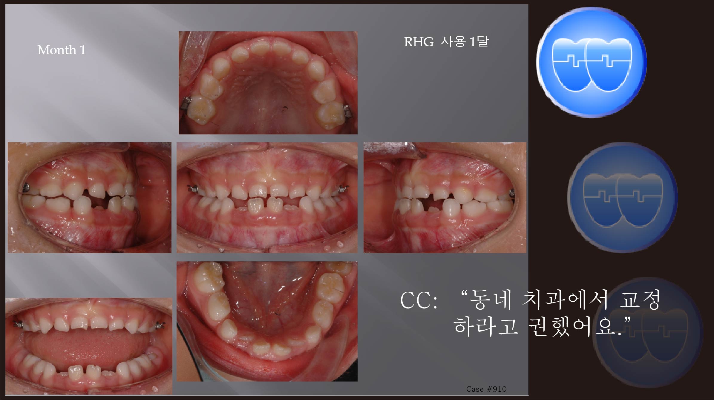 교정 Case 910.  1차 교정, Class III, RHG, Sem #9