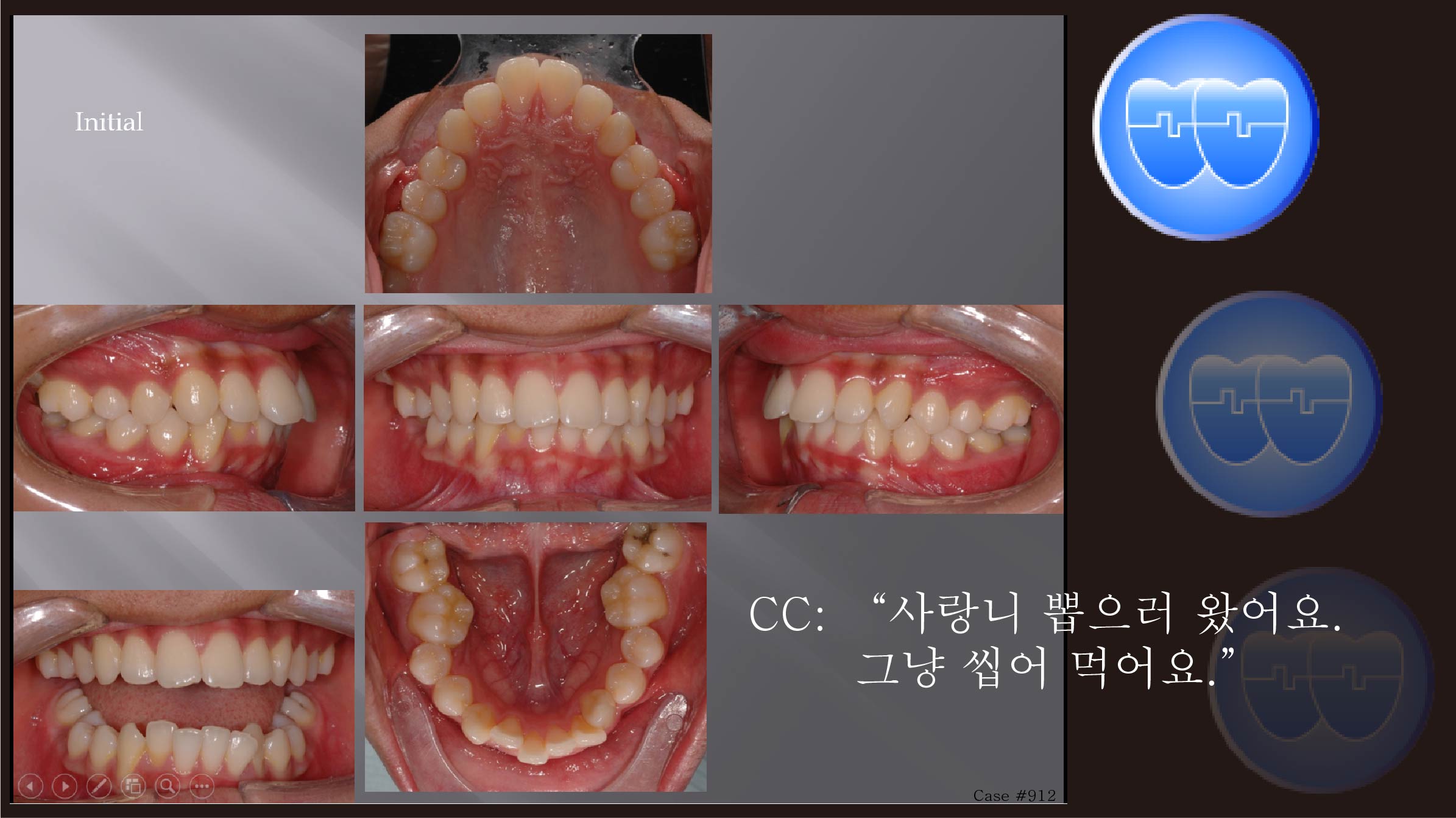 교정 Case 912.  U5L5 발치, Bilateral Posterior Scissor-bite, Sem #7.8