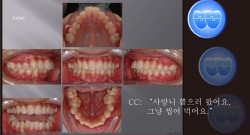 교정 Case 912.  U5L5 발치, Bilateral Posterior Scissor-bite, Sem #7.8