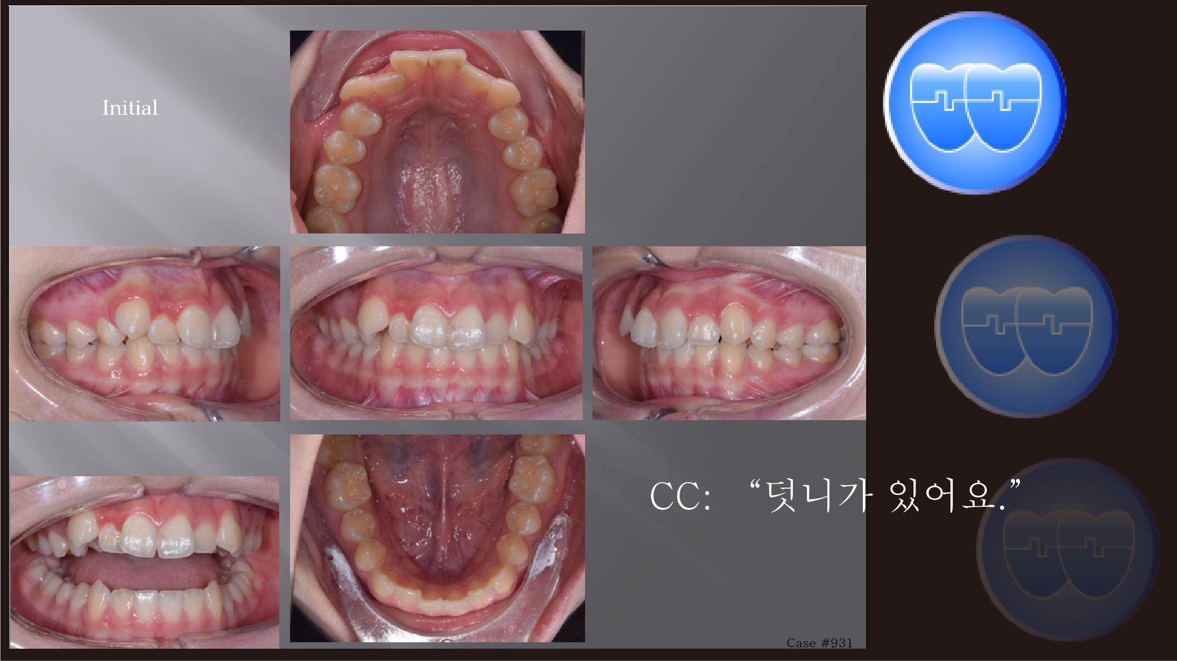 교정 Case 931.  U4 발치, Dental Class II, Upper Severe Crowding, Sem #12.5