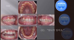 교정 Case 931.  U4 발치, Dental Class II, Upper Severe Crowding, Sem #12.5