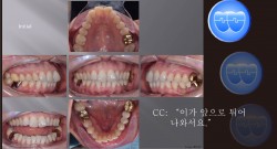 교정 Case 933.  비대칭 발치, 성인, Upper Palatal Corticotomy, Sem #13.2