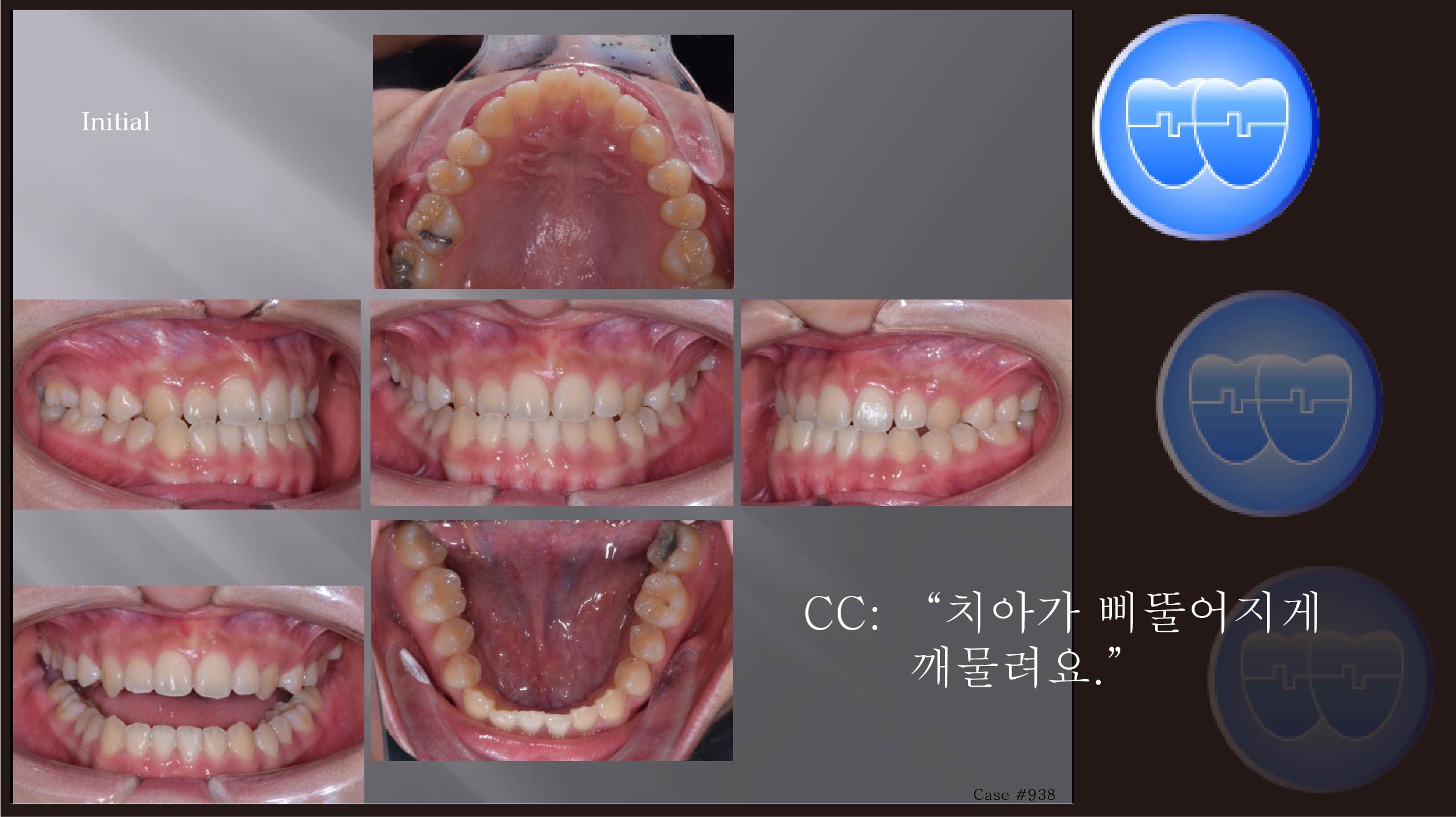 교정 Case 938.  비발치, Class III, Anterior Crossbite, Functional Shift, Midline, Sem #6