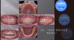 교정 Case 938.  비발치, Class III, Anterior Crossbite, Functional Shift, Midline, Sem #6