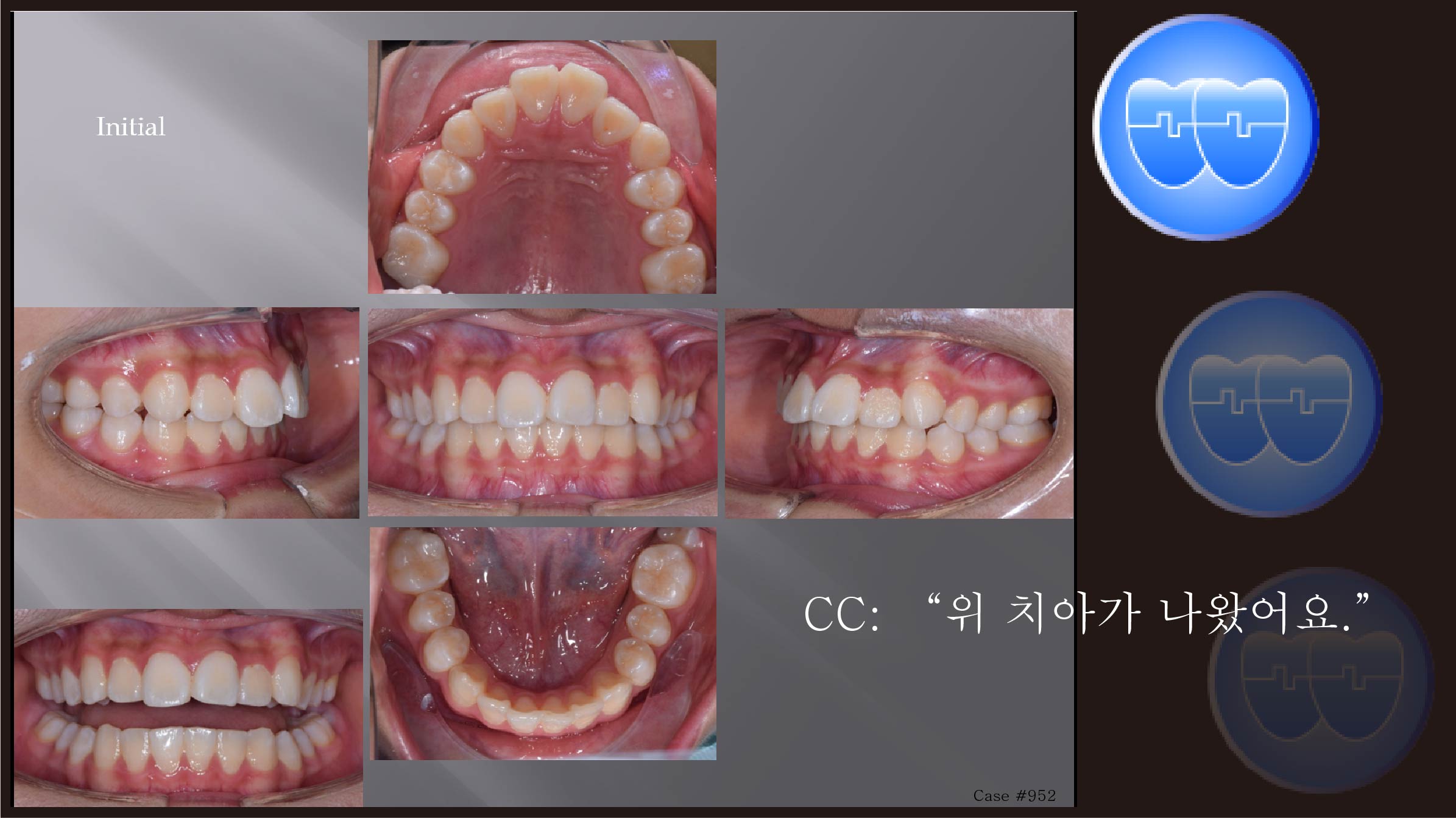 교정 Case 952.  비발치, Dental Class II, IMPA 각도 정의, Growing Pt., Sem #15