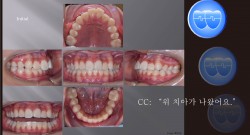 교정 Case 952.  비발치, Dental Class II, IMPA 각도 정의, Growing Pt., Sem #15