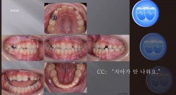 교정 Case 953.  1차 교정, Impaction of #22, Sem #9