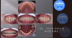 교정 Case 964.  비발치, Anterior Lower Space, Prosth-Ortho, Sem 20.5