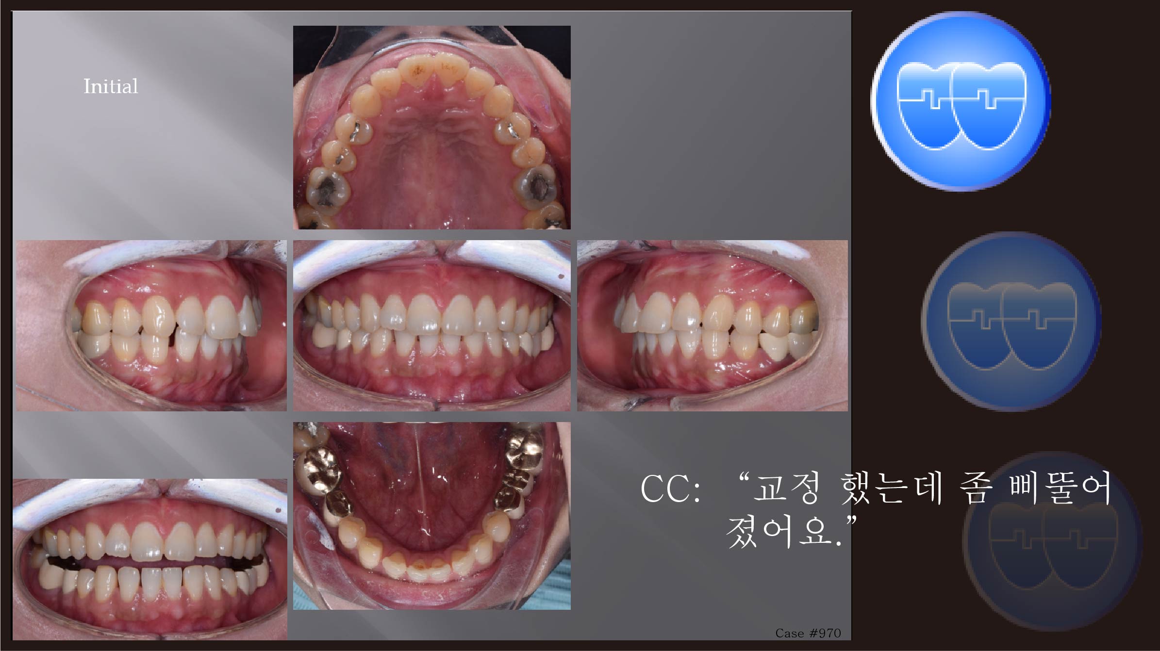 교정 Case 970.  재교정, Tilted Occlusal Table Correction, Sem #7.7