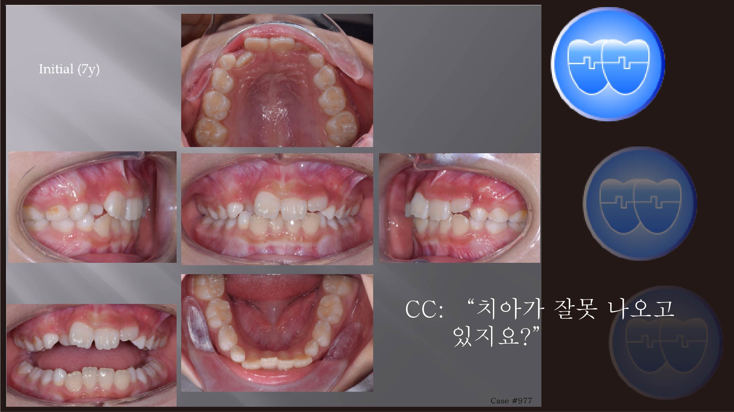 교정 Case 977.  1차 교정, Anterior Crossbite, Sem #9