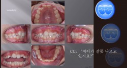 교정 Case 977.  1차 교정, Anterior Crossbite, Sem #9