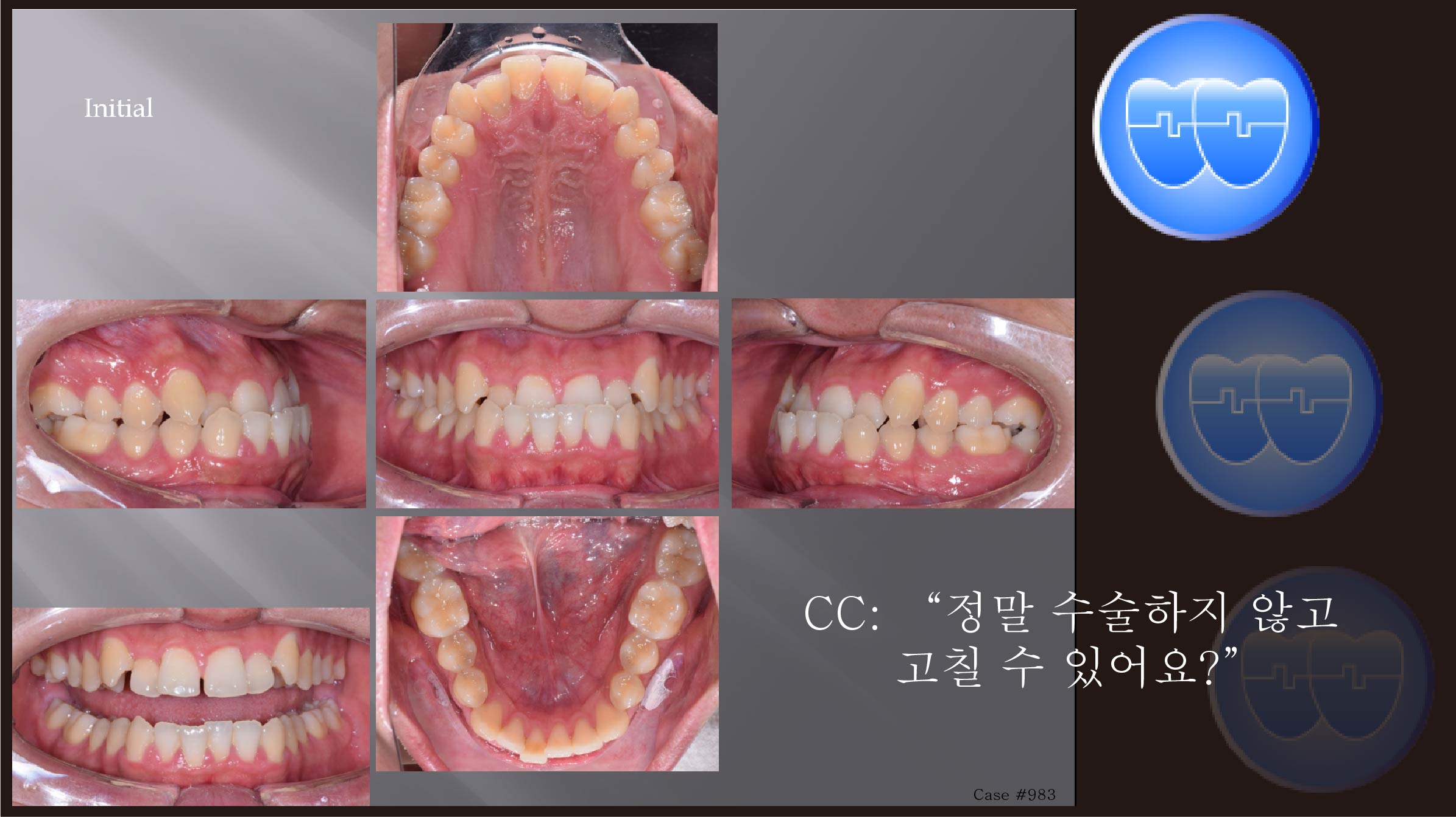 교정 Case 983.  L4 발치, Class III,  Lower Lingual Corticotomy, Arch Coordination, Sem #7.8