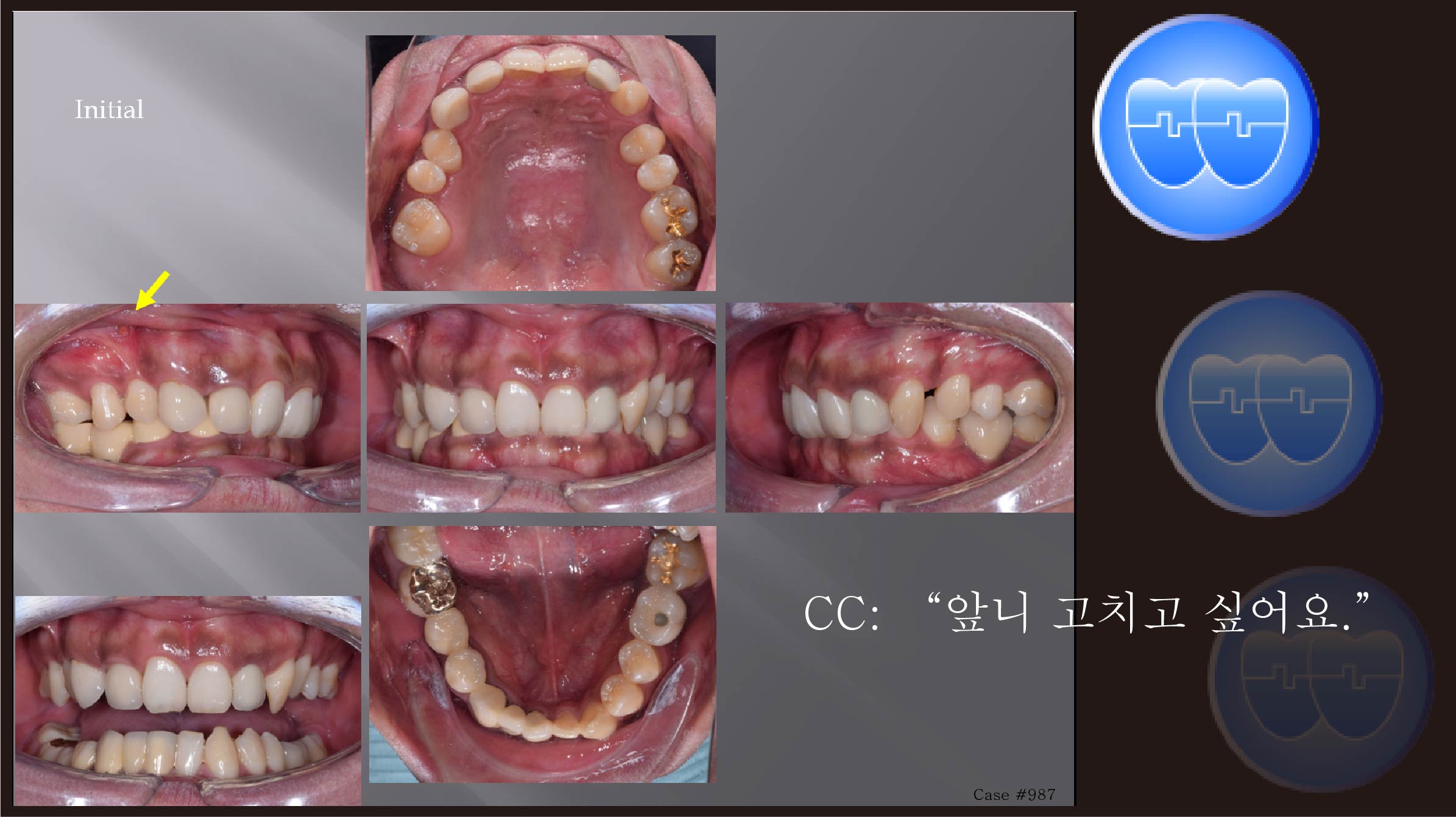 교정 Case 987.  Severe Deepbite, Upper Palatal Corticotomy, 부작용, Gummy Smile, TMJ, Prosth-Ortho, Sem #6