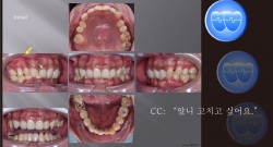 교정 Case 987.  Severe Deepbite, Upper Palatal Corticotomy, 부작용, Gummy Smile, TMJ, Prosth-Ortho, Sem #6