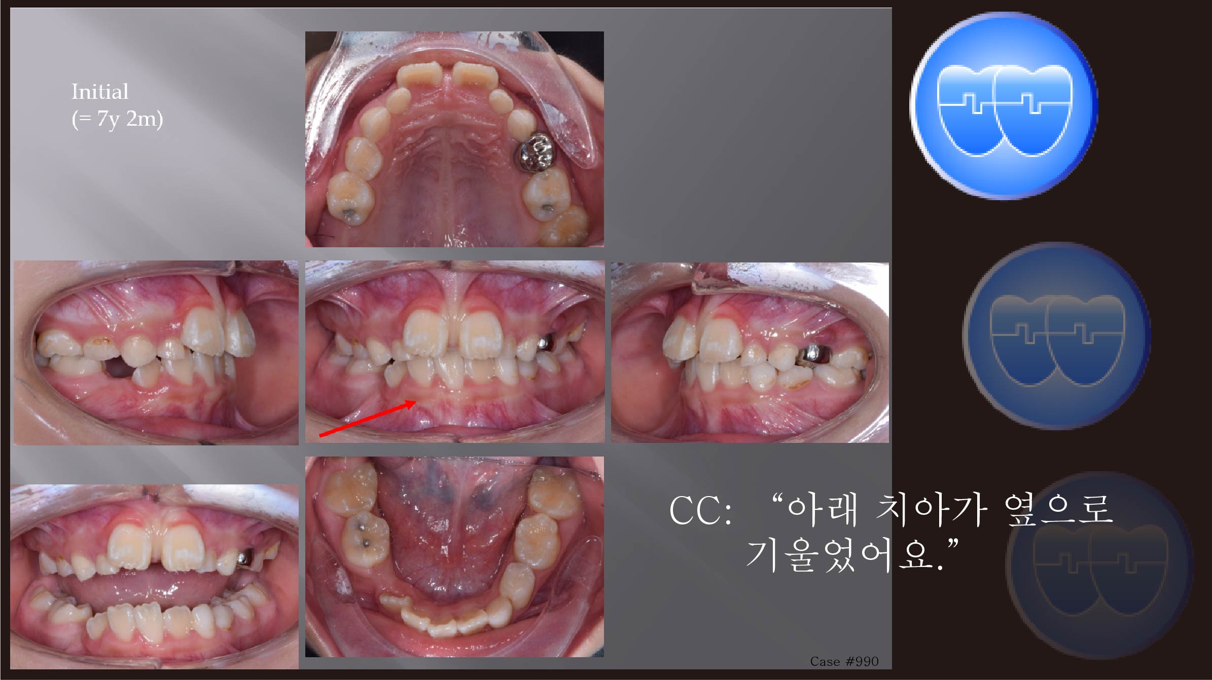 교정 Case 990.  1차 교정, Upper Molar Impaction, Sem #9