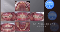 교정 Case 990.  1차 교정, Upper Molar Impaction, Sem #9