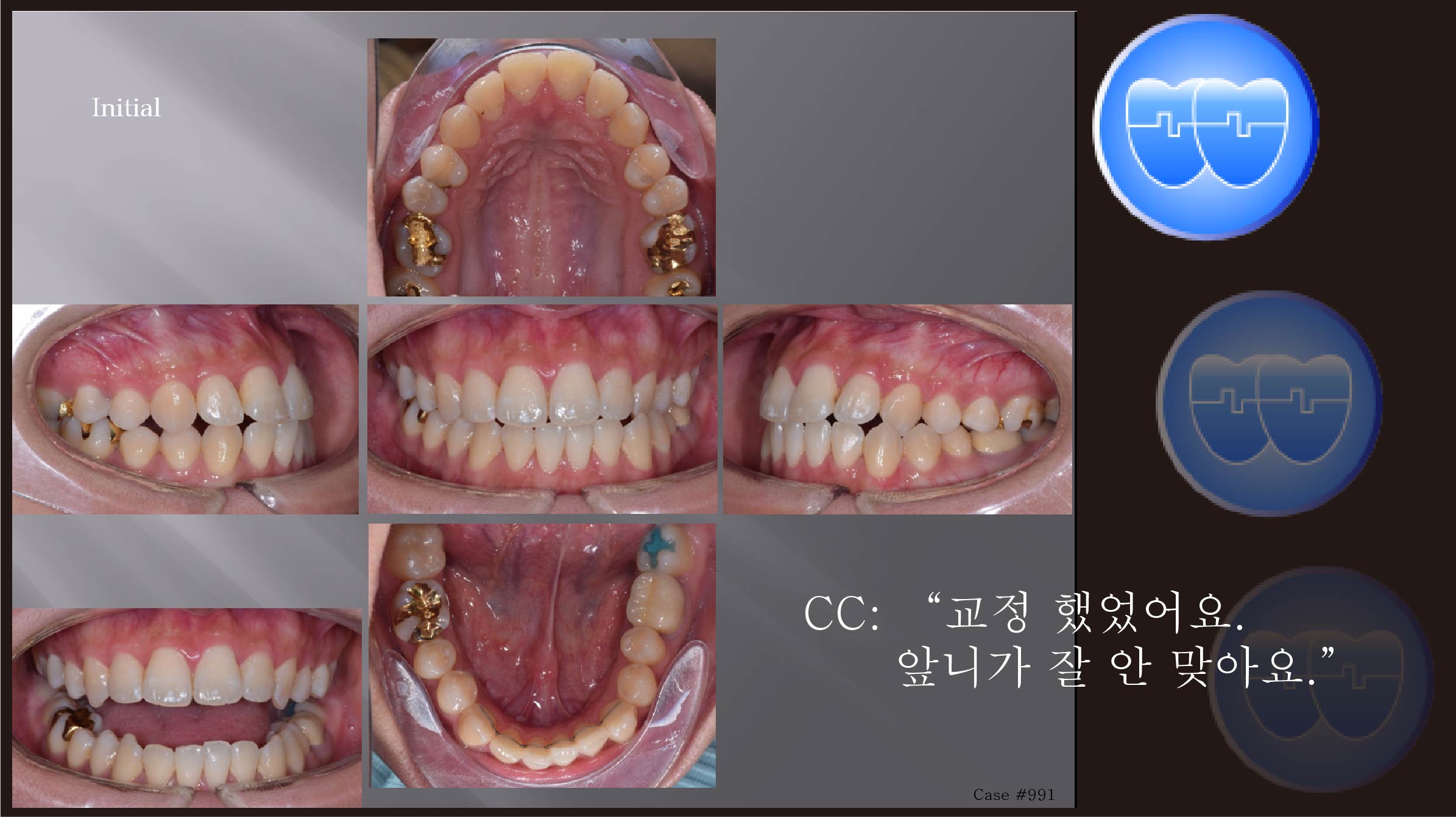 교정 Case 991.  L1 발치, Class III, Midline, Functional Shift, Lower Lingual Corticotomy, Sem #13