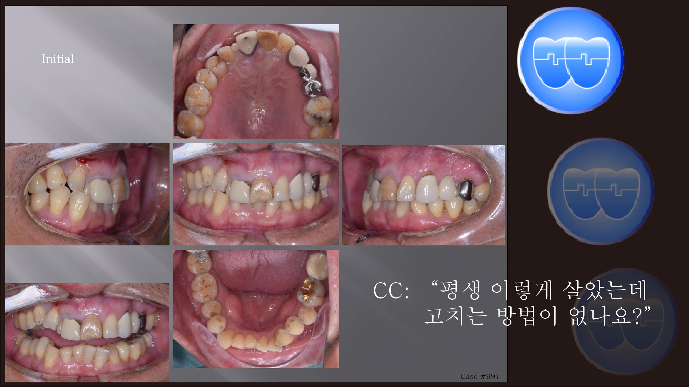 교정 Case 997.  #41 발치, Prosth-Ortho, Sem #20.5