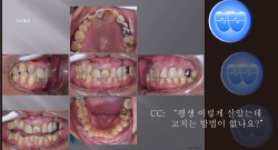 교정 Case 997.  #41 발치, Prosth-Ortho, Sem #20.5