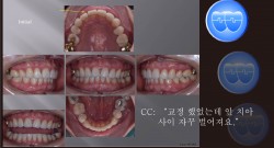 교정 Case 1001.  U4L4 발치, 재교정, Root Resorption, Concave Profile, Sem #10