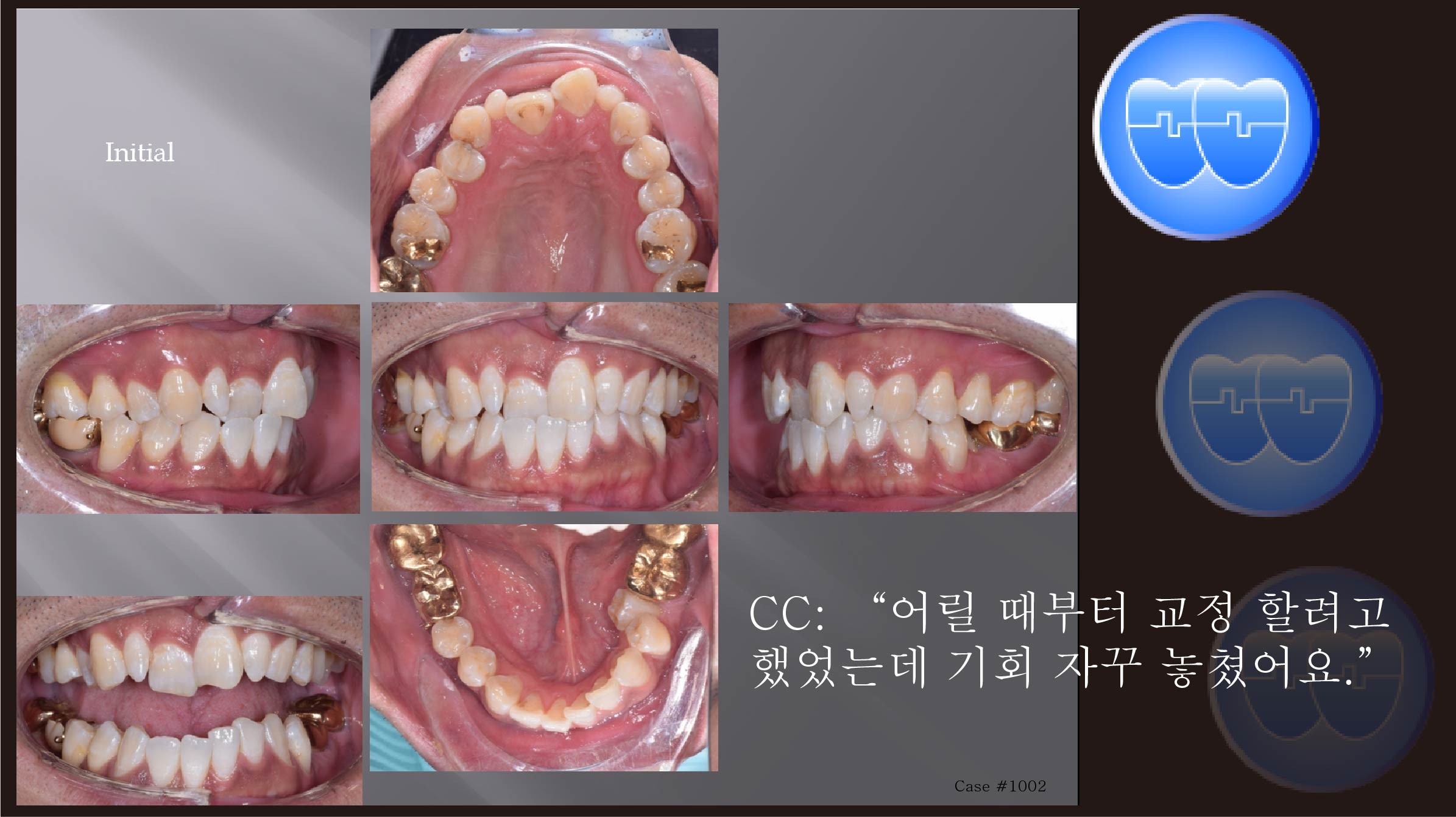 교정 Case 1002.  비발치, Tilted Occlusal Table, 교정 중 TMJ 문제 호소, Sem #19