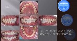 교정 Case 1002.  비발치, Tilted Occlusal Table, 교정 중 TMJ 문제 호소, Sem #19