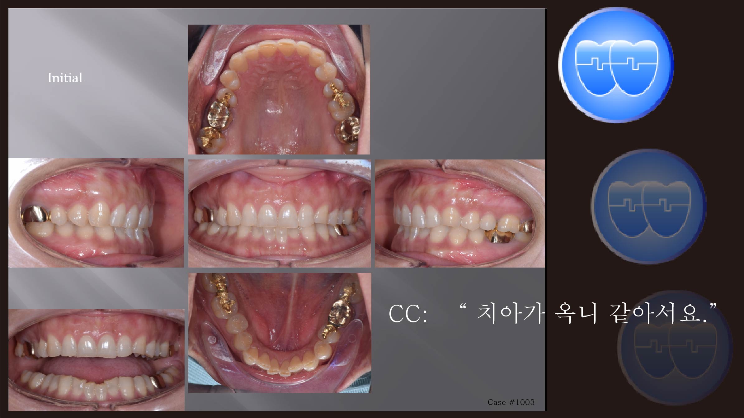 교정 Case 1003.  비발치, 부분 교정, Upper Torque 살리기, Sem #6