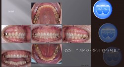 교정 Case 1003.  비발치, 부분 교정, Upper Torque 살리기, Sem #6