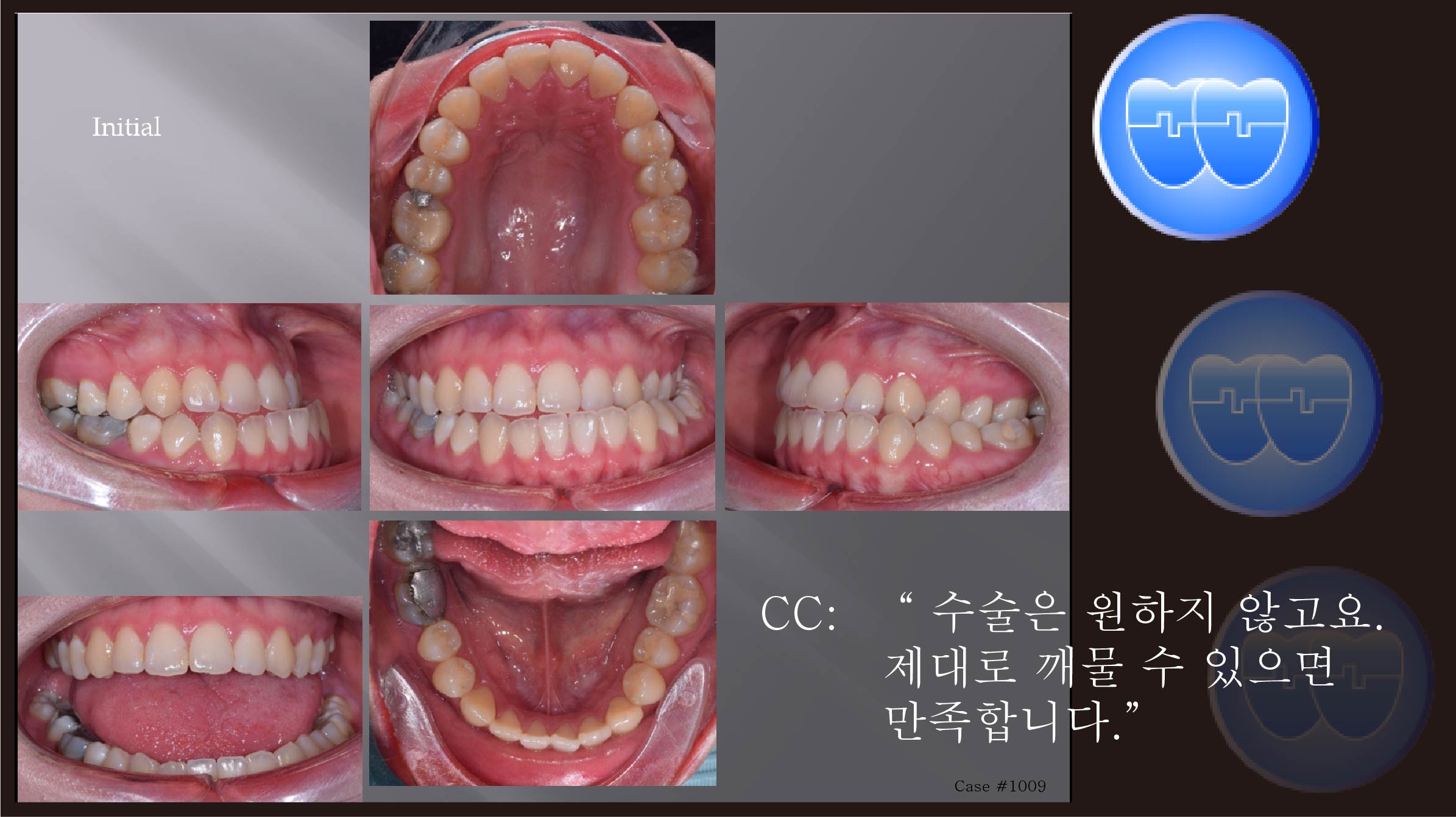 교정 Case 1009.  비발치, 심각한 비대칭, Functional shift, Bonded RPE, Sem #19