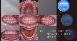 교정 Case 1009.  비발치, 심각한 비대칭, Functional shift, Bonded RPE, Sem #19