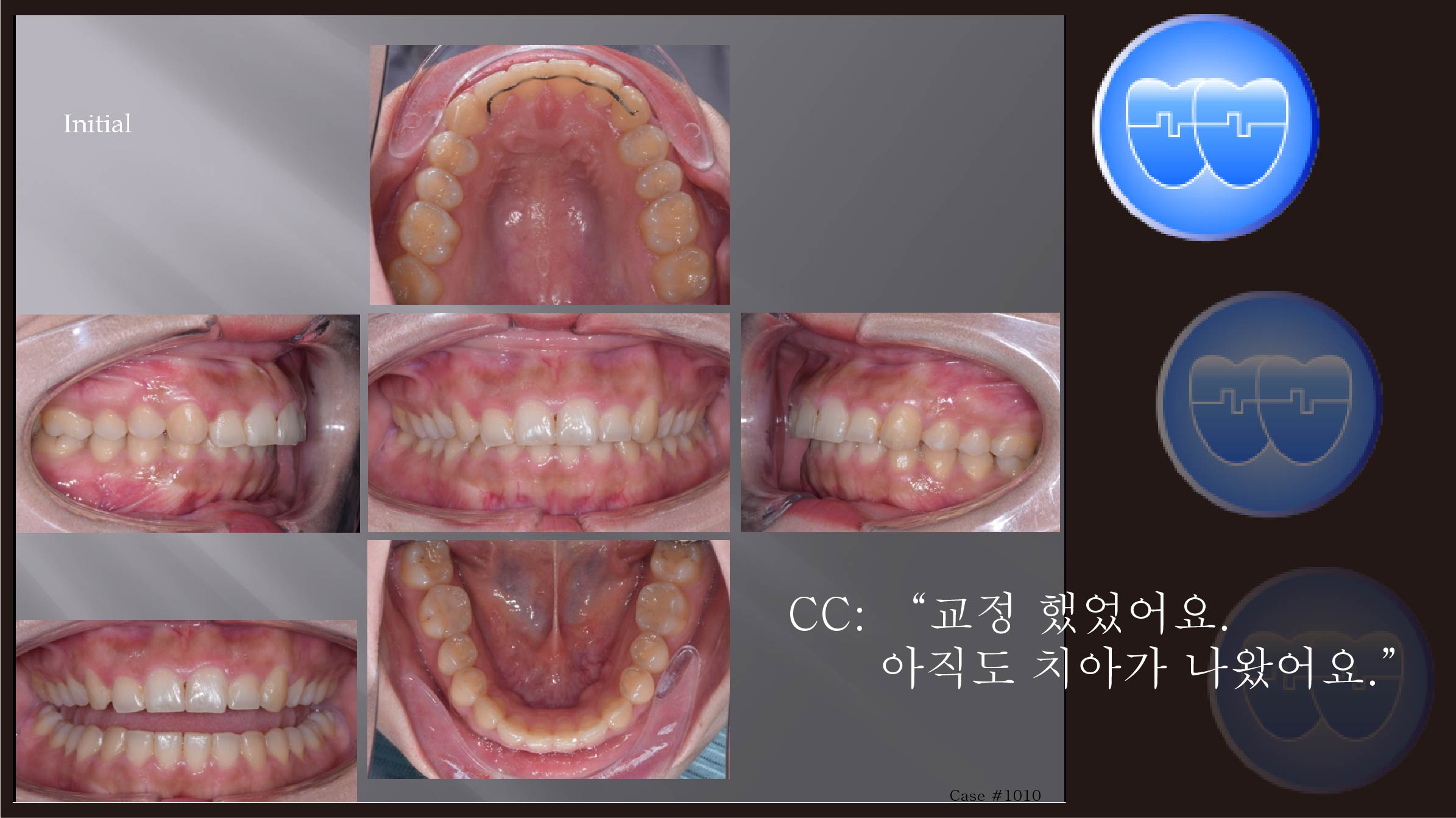 교정 Case 1010.  U4 발치, 재교정, Upper Palatal Corticotomy, Root Resorption, Sem #12.5