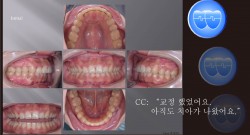 교정 Case 1010.  U4 발치, 재교정, Upper Palatal Corticotomy, Root Resorption, Sem #12.5