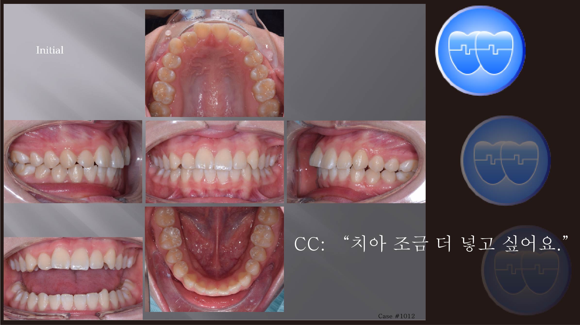 교정 Case 1012.  비발치, Midline, 교정 중 #13 통증호소, Cortical Bone Perforation, Sem # 6