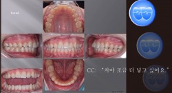 교정 Case 1012.  비발치, Midline, 교정 중 #13 통증호소, Cortical Bone Perforation, Sem # 6