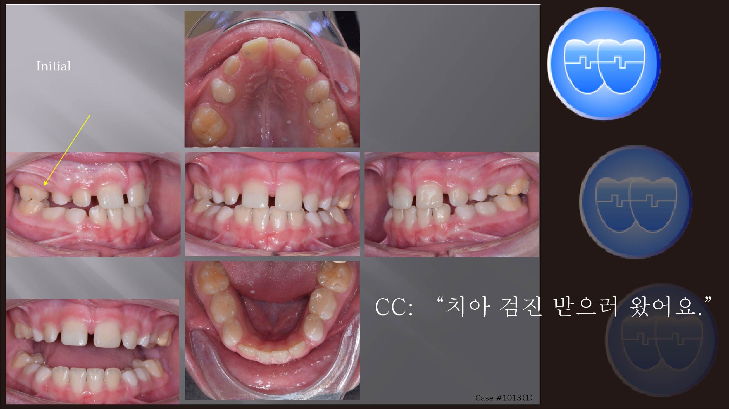 교정 Case 1013(1).  1차 교정, Rotated #16, Advancing Z Arch, Sem #9