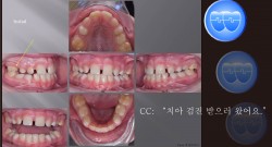 교정 Case 1013(1).  1차 교정, Rotated #16, Advancing Z Arch, Sem #9