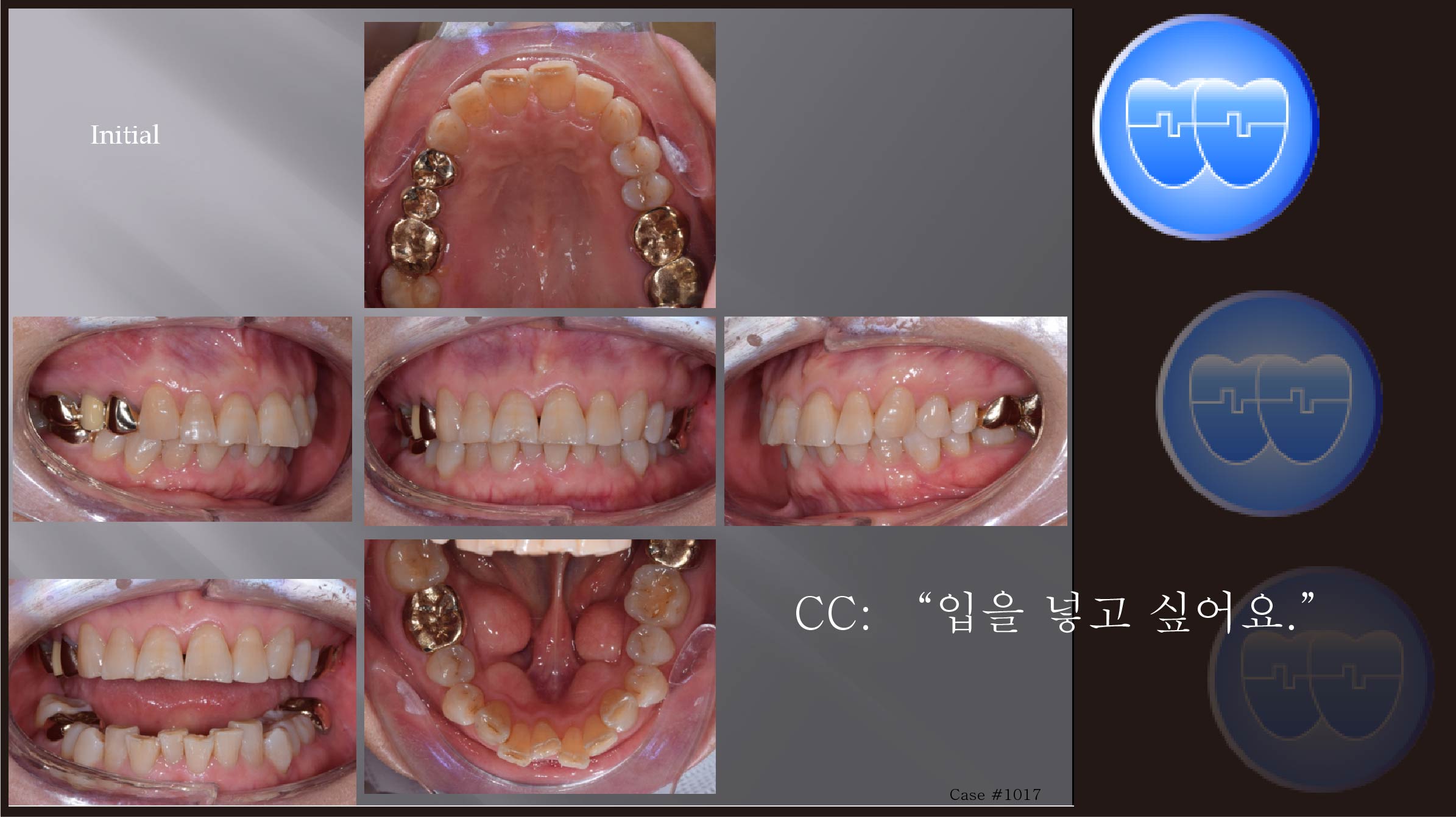 교정 Case 1017.  U5L1 발치, Big Tori, Lower Lingual Corticotomy, Sem # 13