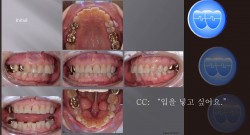 교정 Case 1017.  U5L1 발치, Big Tori, Lower Lingual Corticotomy, Sem # 13