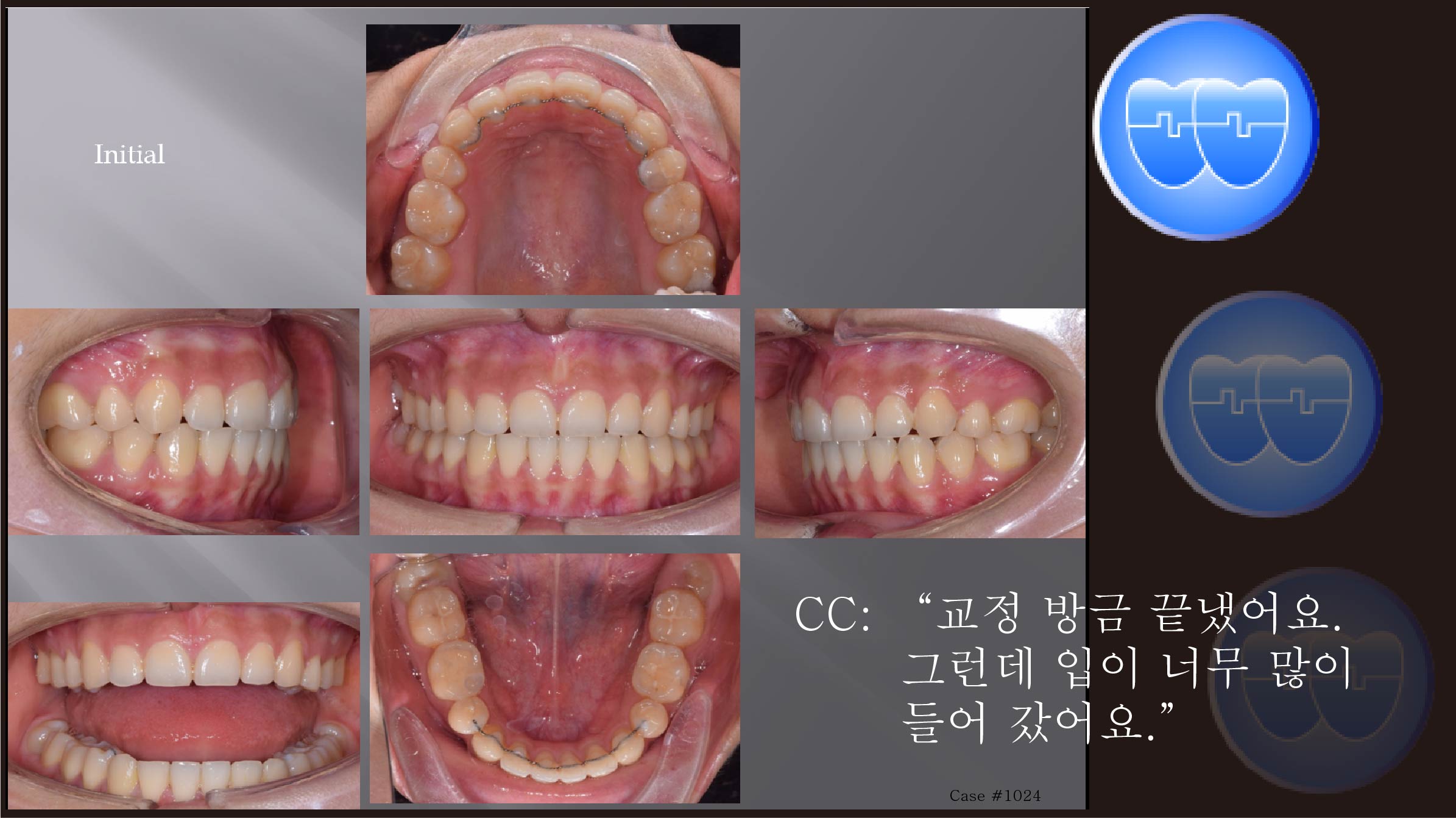 교정 Case 1024.  U4L4 발치, 재교정, Retraction된 profile을 고치기 위해서, Sem #10