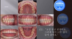 교정 Case 1024.  U4L4 발치, 재교정, Retraction된 profile을 고치기 위해서, Sem #10