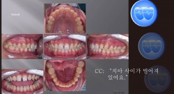 교정 Case 1026.  비발치, Anterior Space Closure, 턱빠짐, Friction Control, Sem #5