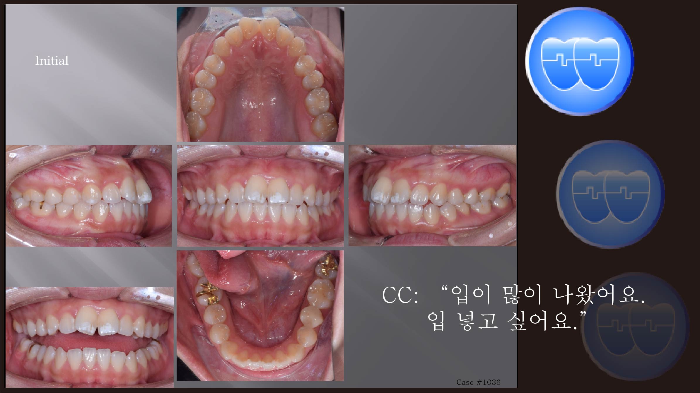 교정 Case 1036.  U5L5 발치, Protrusion, Class III, Lower Lingual Corticotomy, Sem #13.7