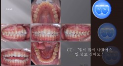 교정 Case 1036.  U5L5 발치, Protrusion, Class III, Lower Lingual Corticotomy, Sem #13.7