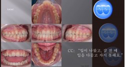 교정 Case 1037.  U5L4 발치, Skeletal Resistance, Lower Lingual Corticotomy, Torque Complication, Sem #13.7