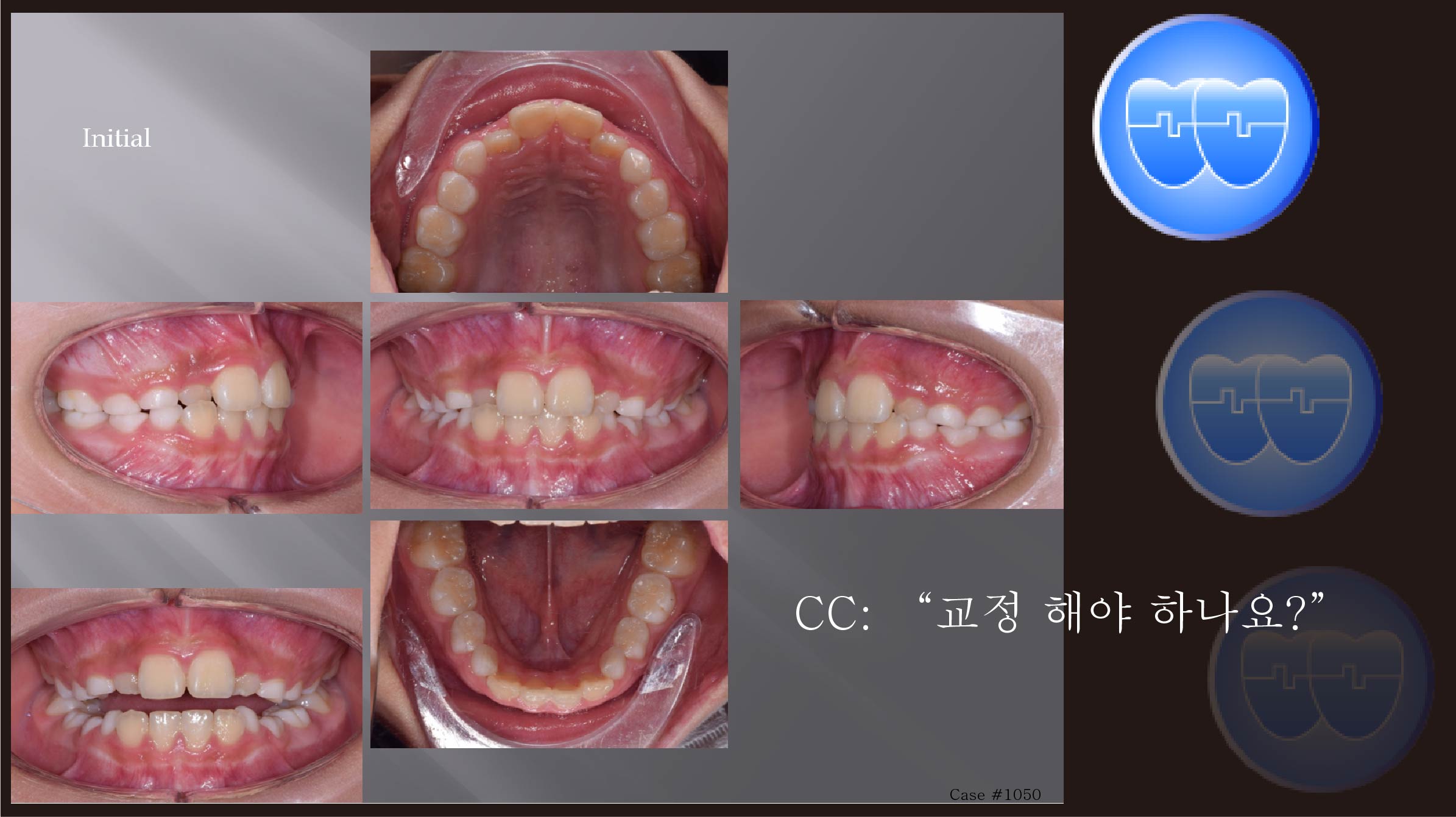 교정 Case 1050.  1차교정, Anterior Crossbite, Sem #9