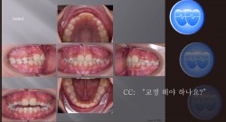 교정 Case 1050.  1차교정, Anterior Crossbite, Sem #9