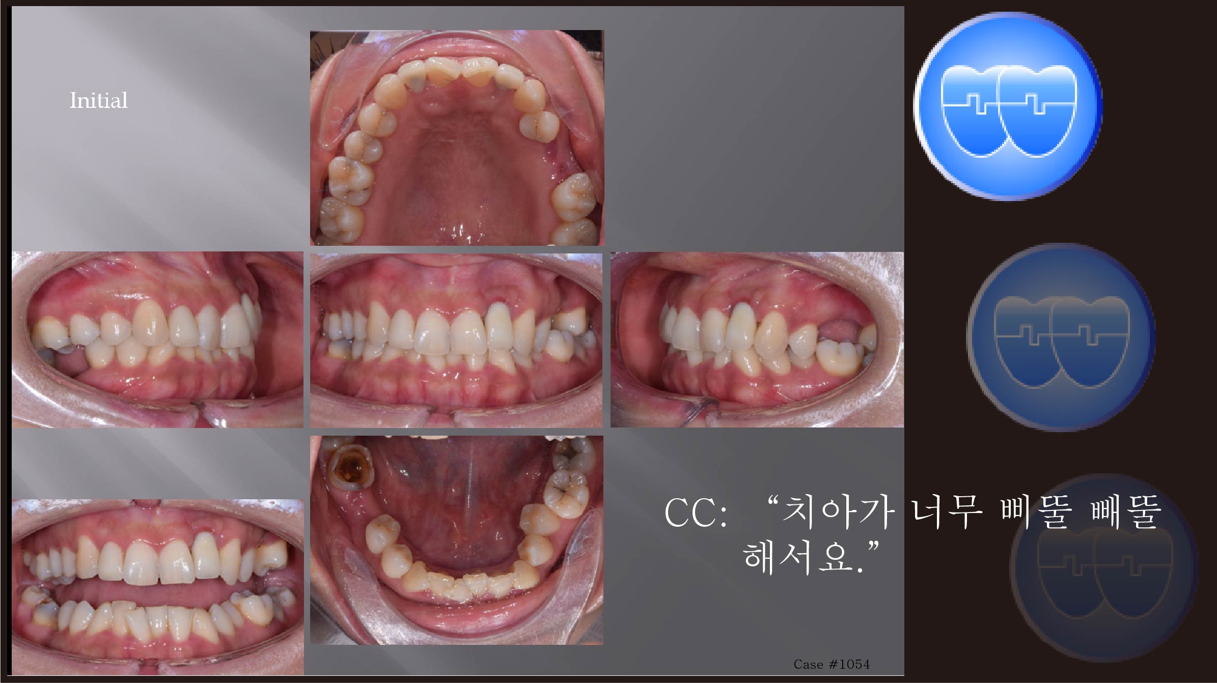 교정 Case 1054.  비대칭 발치, #22 Implant Anchorage 활용, Deepbite, Sem #6