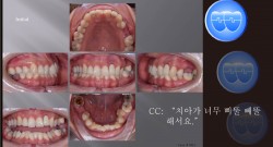 교정 Case 1054.  비대칭 발치, #22 Implant Anchorage 활용, Deepbite, Sem #6