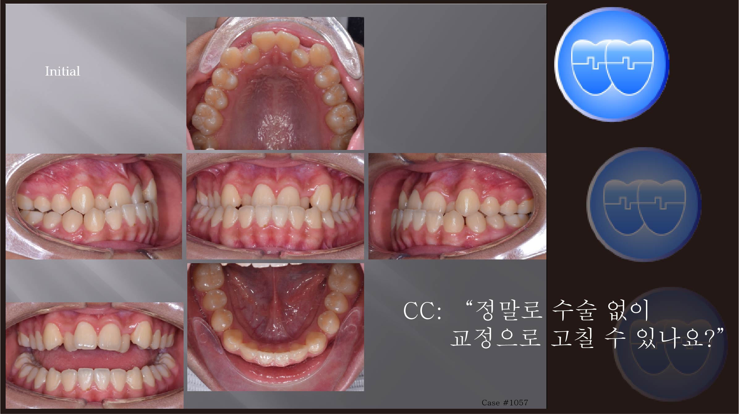 교정 Case 1057.  U5L4 발치, Severe Class III, Anterior Crossbite, Lower Lingual Corticotomy, Sem #13.7