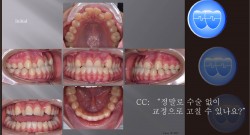 교정 Case 1057.  U5L4 발치, Severe Class III, Anterior Crossbite, Lower Lingual Corticotomy, Sem #13.7